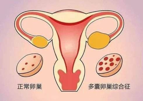 双侧输卵管堵塞，幸好还有试管婴儿能助我怀孕